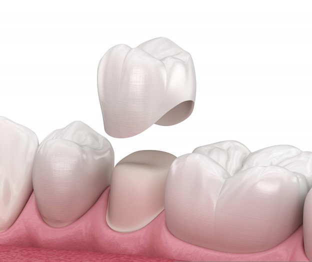 Dental Crown Services in Frenchs Forest